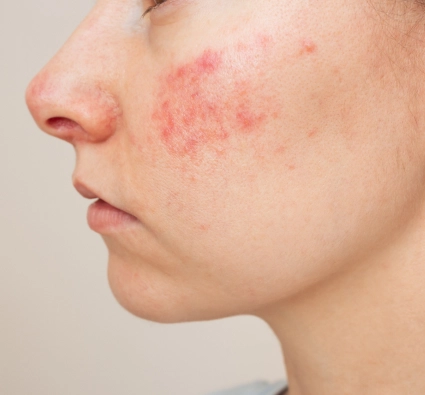 Face Image - chronic skin conditions